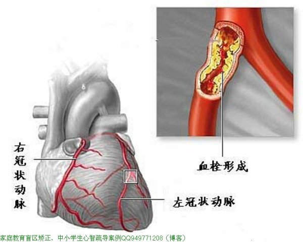 血管是如何一天天堵塞的