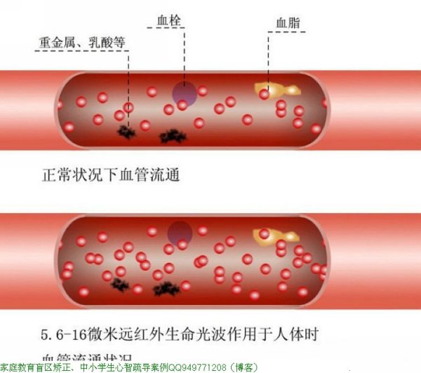 血管是如何一天天堵塞的