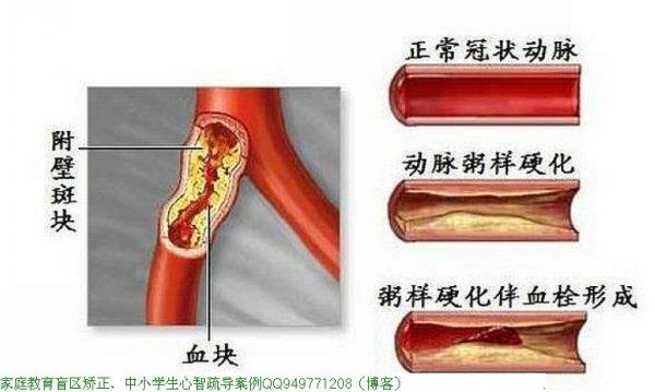 血管是如何一天天堵塞的