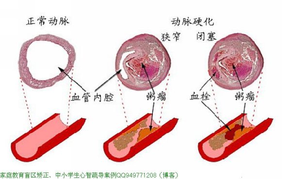 血管是如何一天天堵塞的